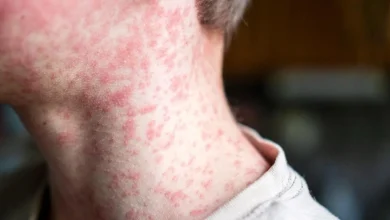 cbsn fusion more measles cases reported in texas thumbnail Detafour