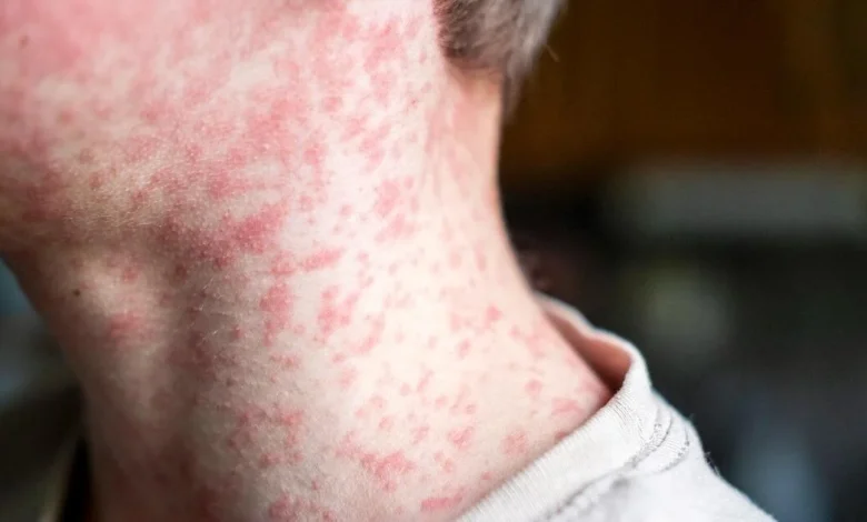 ارتفاع حالات الإصابة بالحصبة في تكساس إلى 146 حالة مع وفاة واحدة 1 cbsn fusion more measles cases reported in texas thumbnail Detafour